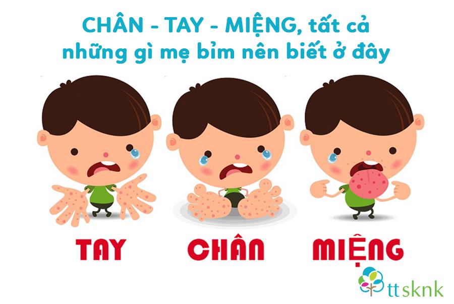 Cách xử lý khi trẻ bị bệnh chân - tay - miệng