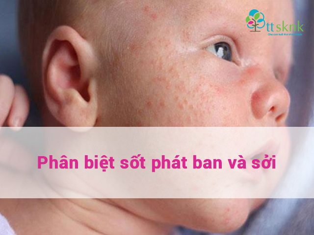 phân biệt sốt phát ban và sởi