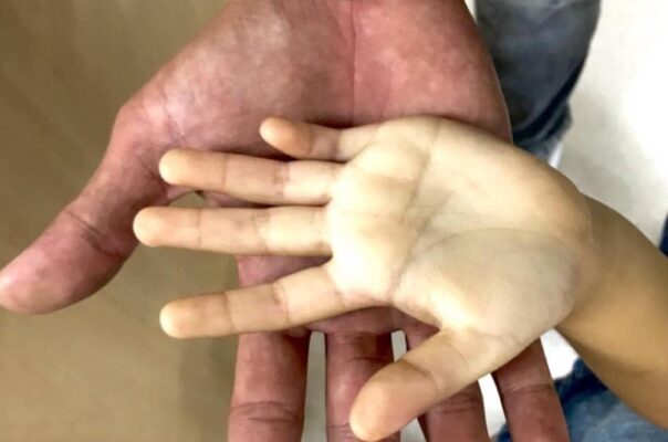 Uống sữa dài ngày làm tăng nguy cơ thiếu máu do thiếu sắt ở trẻ